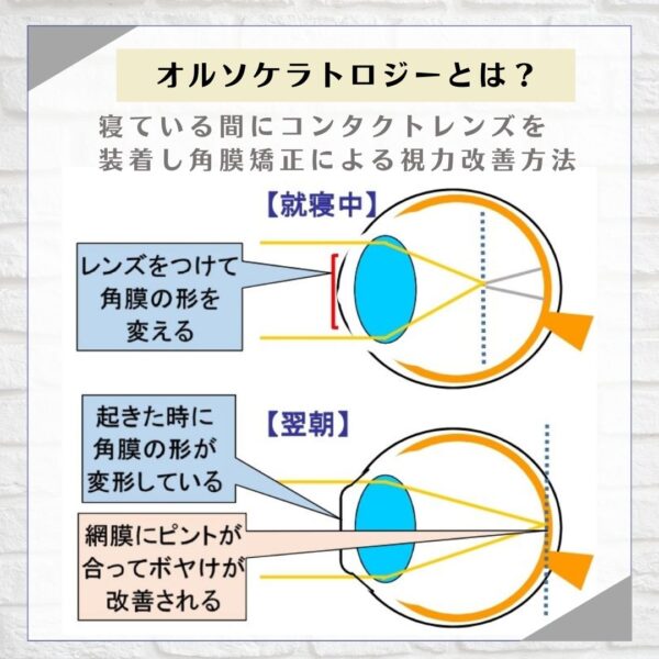 オルソケラトロジーの仕組み